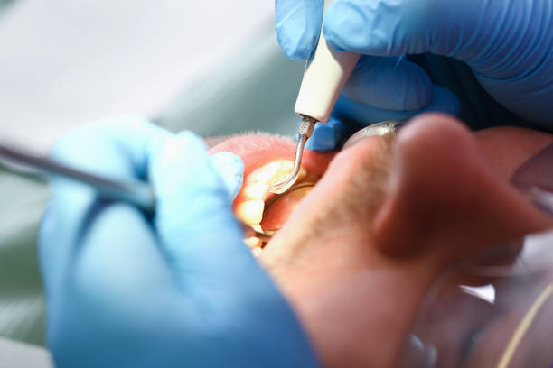 Best Root Canal Emergency Dentist  in Silver Firs, WA